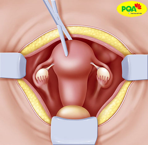 Phẫu thuật cắt một phần hoặc hoàn toàn tử cung khi bị nặng