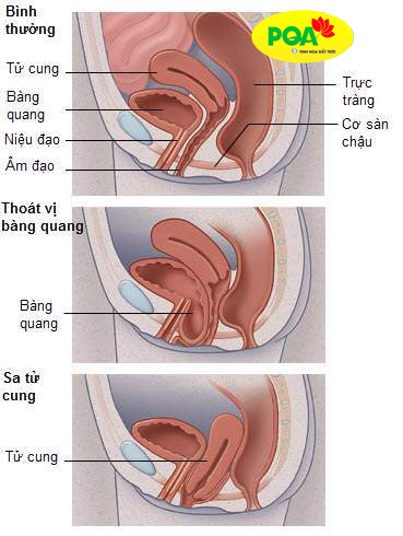 Hình ảnh bộ phận tử cung, trực tràng, bàng quang